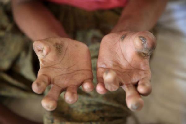 Penanggulangan Kusta di Indonesia Terhambat oleh Pandemi Covid-19
