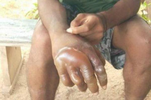 Guru STM Bina Karya Larantuka Siksa Siswa  dengan Celup Tangan ke Air Panas